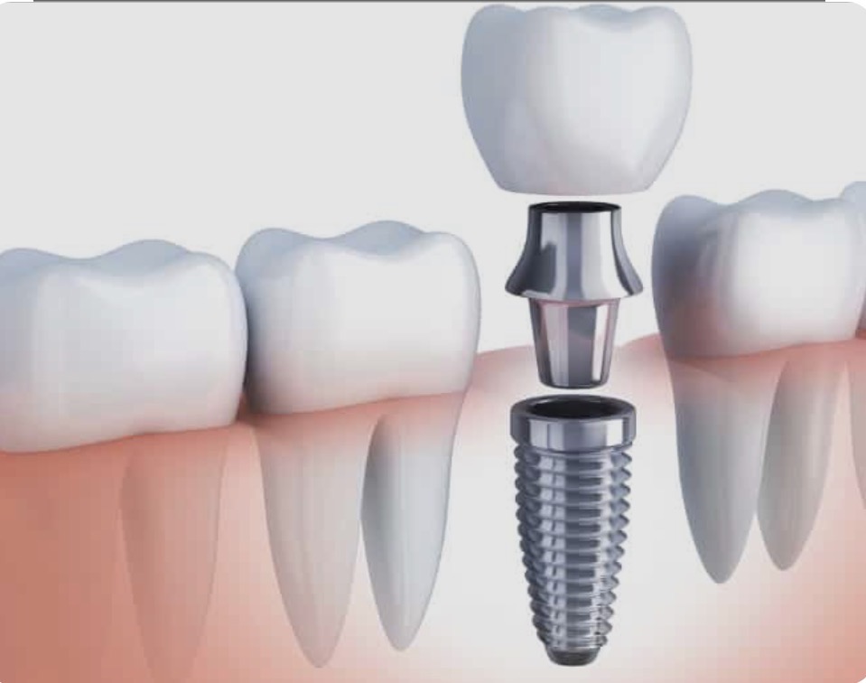 Zahnersatz & Implantate